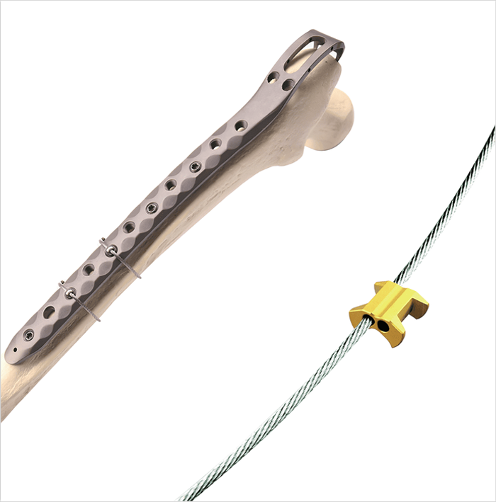 Titanium Cable Fixation System (Sterile Packaging)