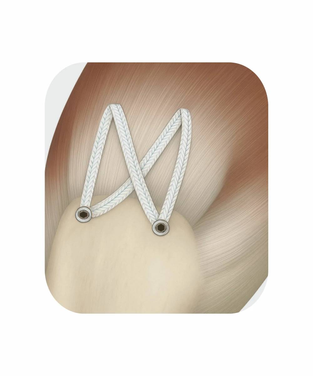 Surgical Tape Energybraid