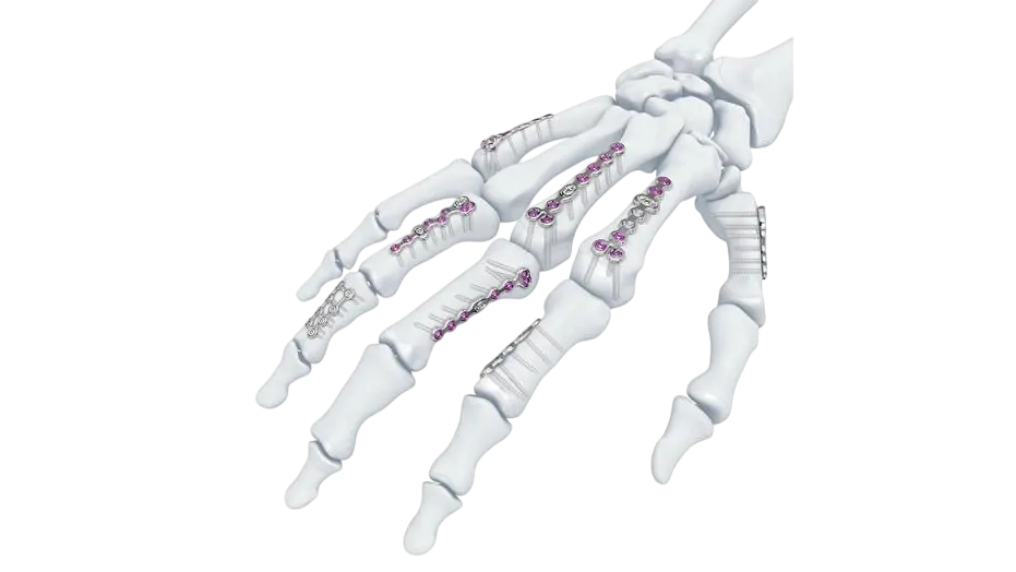 Trauma implants